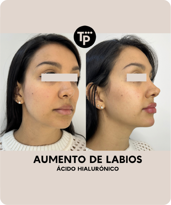 Aumento de labios