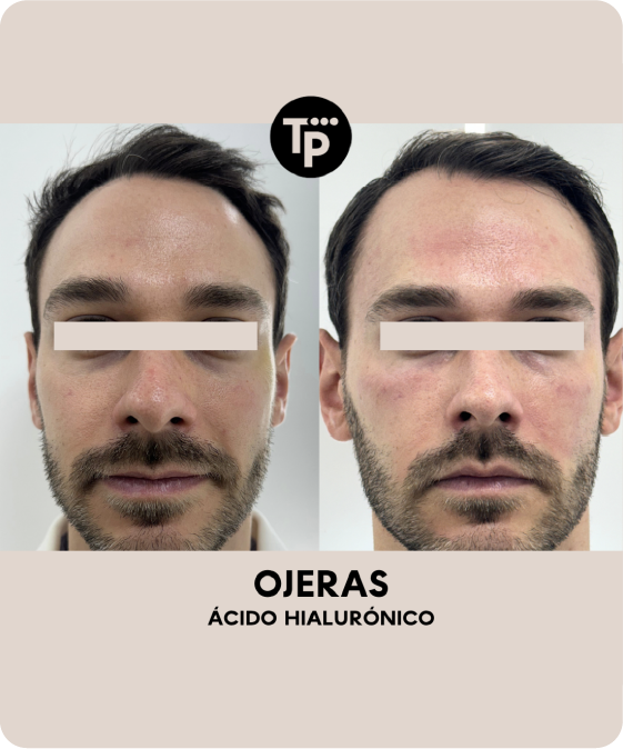 Ojeras