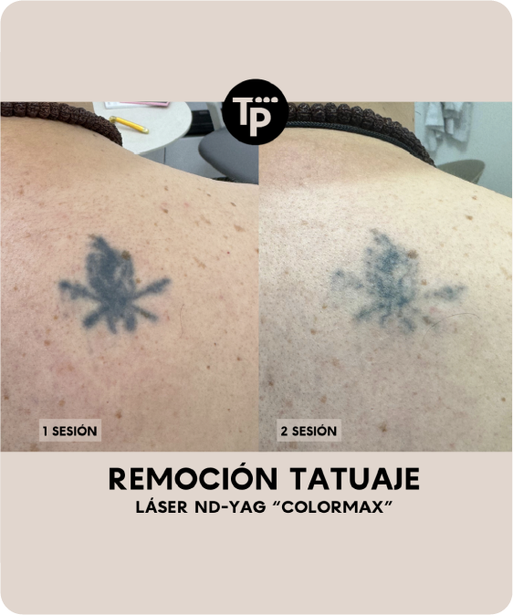 Remoción tatuaje