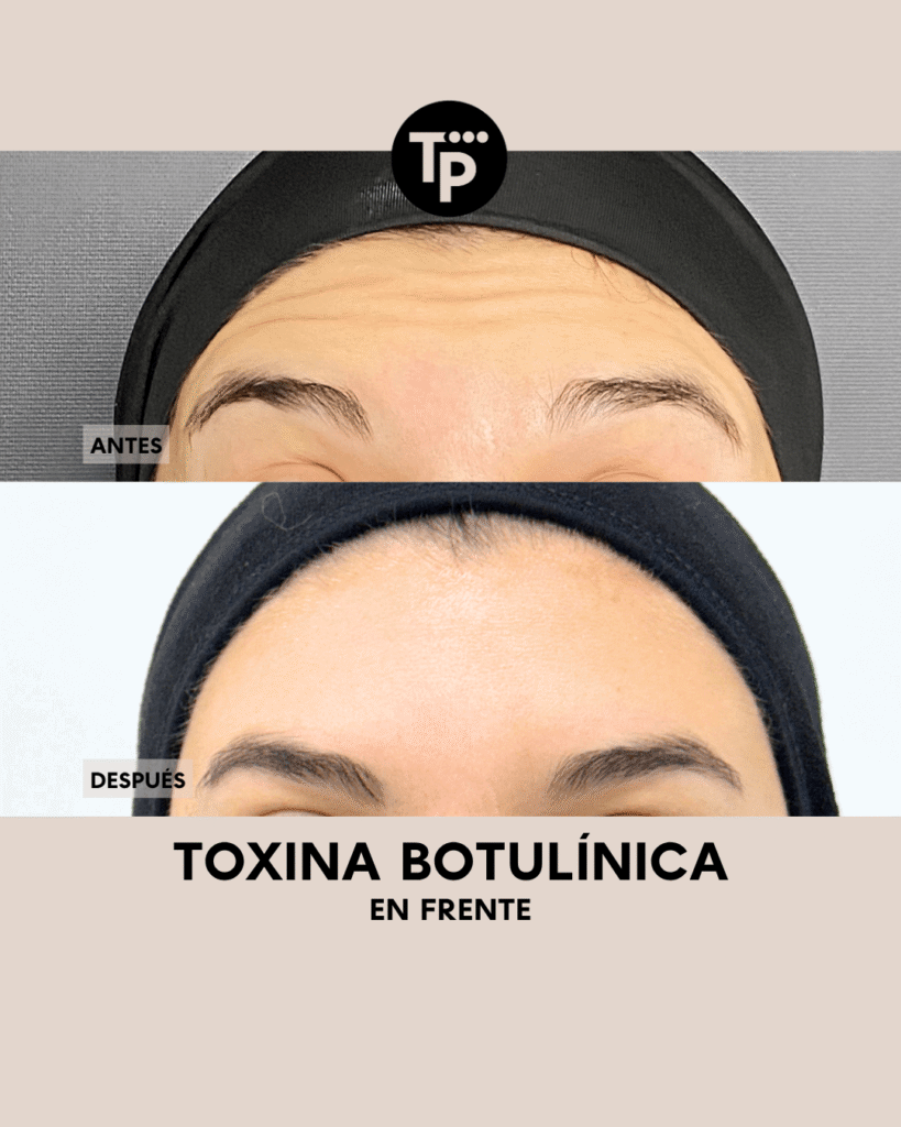 BOTOX - PAULA BLOG (1)