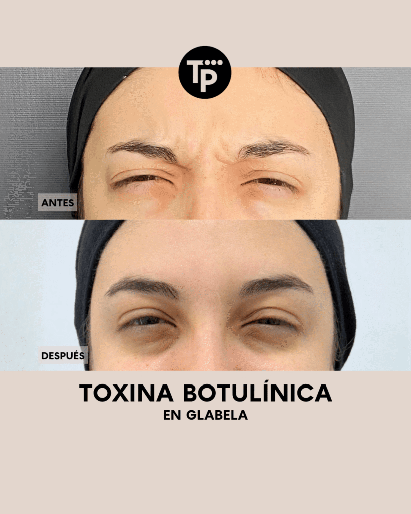 BOTOX - PAULA BLOG (2) (1)
