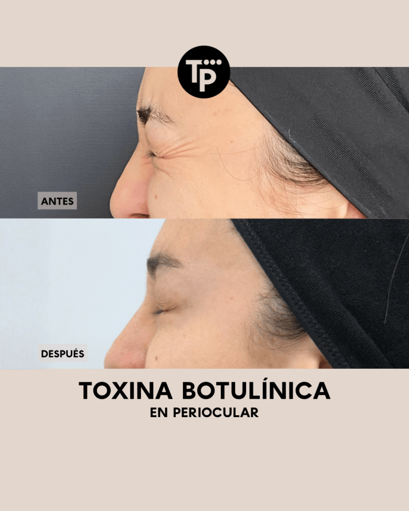 BOTOX - PAULA BLOG (3) (1)