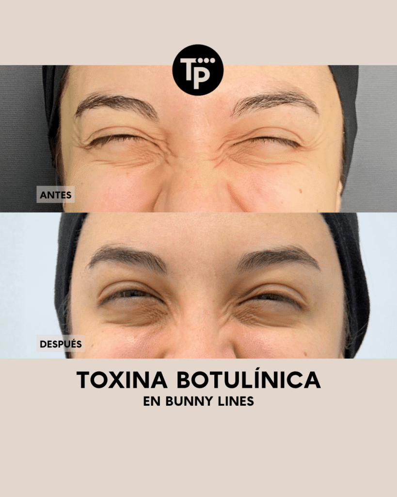 BOTOX - PAULA BLOG (4) (1)