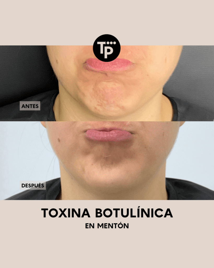 BOTOX - PAULA BLOG (5) (1)